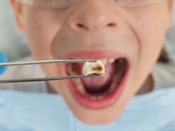 Best Emergency Dental Care for Abscessed Tooth in Catonsville, MD
